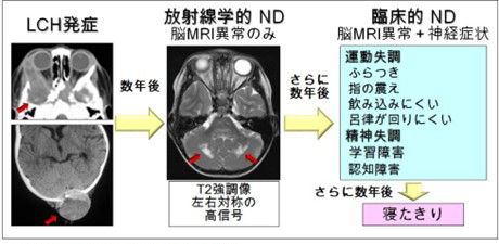 図1.LCH関連中枢神経変性症の典型的な経過