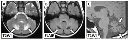 A.小脳虫部の左右対称性T2高信号病変　B.嚢胞状変化　C.著しい小脳萎縮